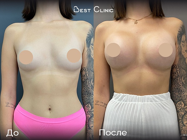 Увеличение груди