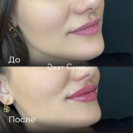 Увеличение губ