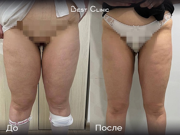 Липосакция бедер