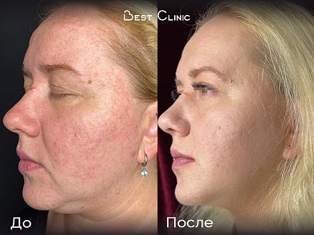 Игольчатый RF-лифтинг