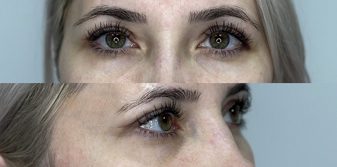 Блефаропластика 