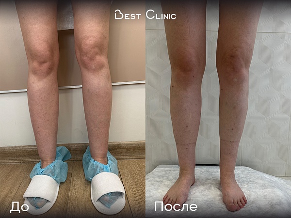 Липосакция голеней