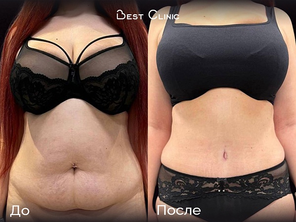 Абдоминопластика