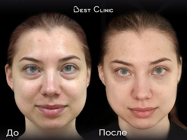 Трансконъюктивальная нижняя блефаропластика + липофилинг носослезной борозды