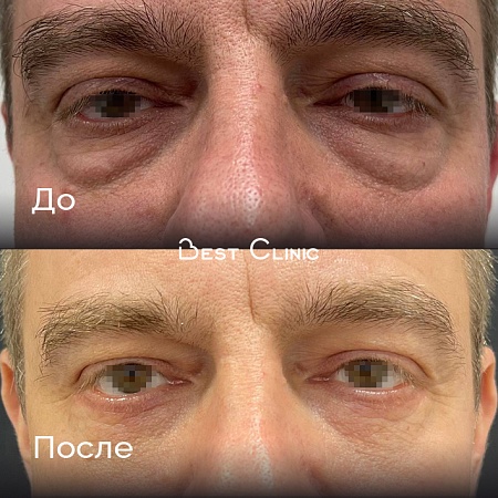 Нижняя блефаропластика