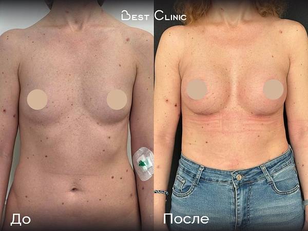 Увеличение груди