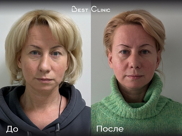 Риносептопластика реконструктивная