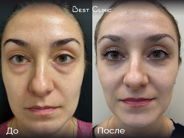 Нижняя трансконъюктивальная блефаропластика