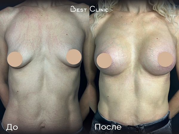 Увеличение груди + коррекция тубулярности