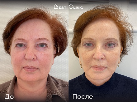 Круговая подтяжка лица + верхняя и нижняя блефаропластика + подтяжка средней и нижней трети лица + пластика шеи