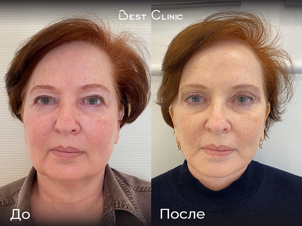 Круговая подтяжка лица + верхняя и нижняя блефаропластика + подтяжка средней и нижней трети лица + пластика шеи