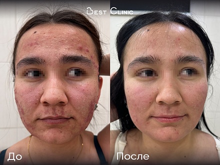 Лечение акне