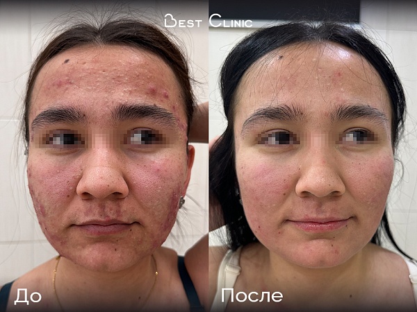 Лечение акне