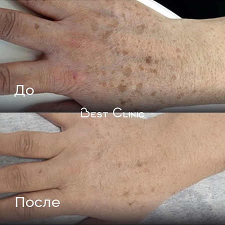 Фотоомоложение рук, работа с пигментом