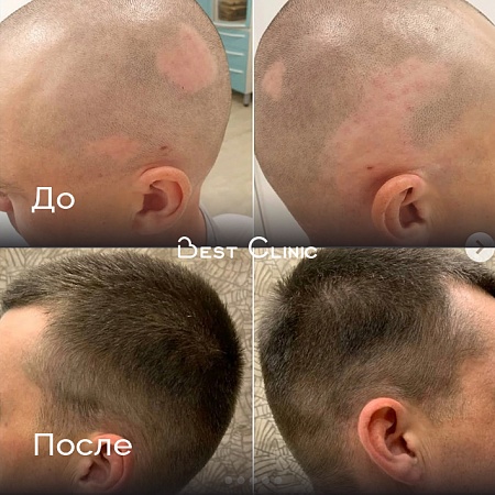 Лечение очаговой алопеции