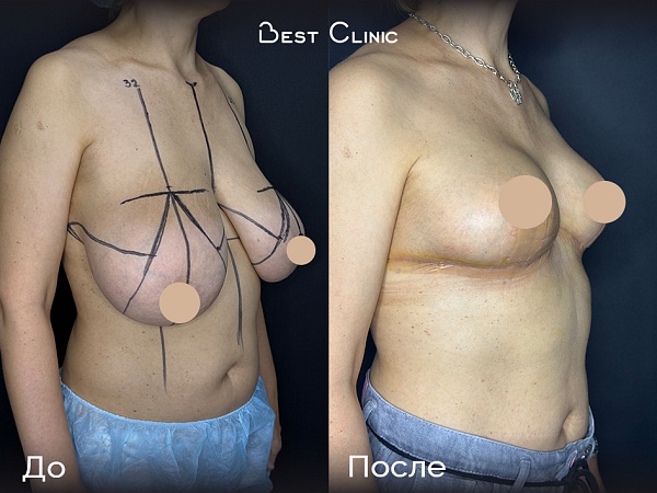 Редукционная мастопексия без имплантов