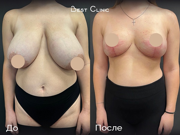 Уменьшение груди