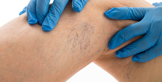 УЗНАЙТЕ ВСЁ О СВОИХ ВЕНАХ ЗА ОДИН ПРИЁМ!