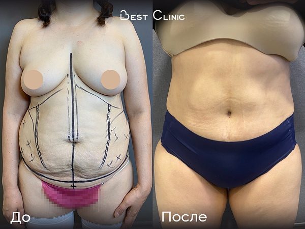 Липоабдоминопластика, ушивание диастаза, липосакция