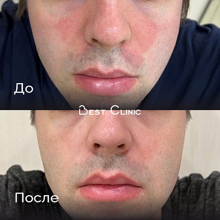 Лечение себорейного псориаза