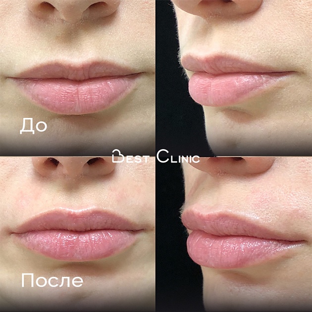 Контурная пластика губ