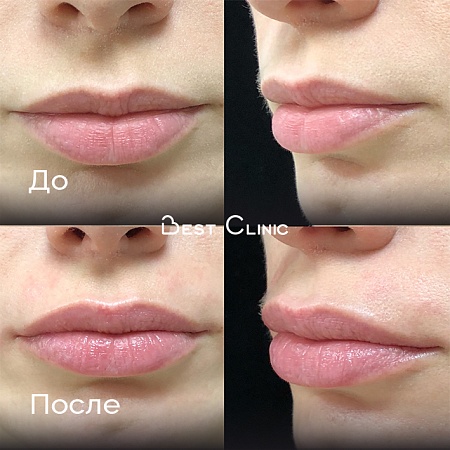 Контурная пластика губ