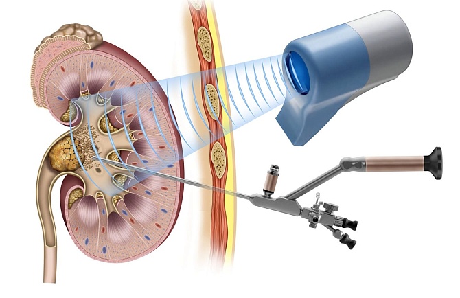 Оперативное лечение мочекаменной болезни. Современные методы