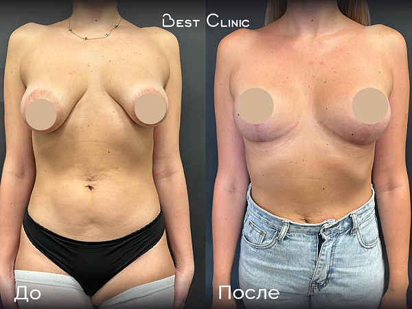 Подтяжка груди