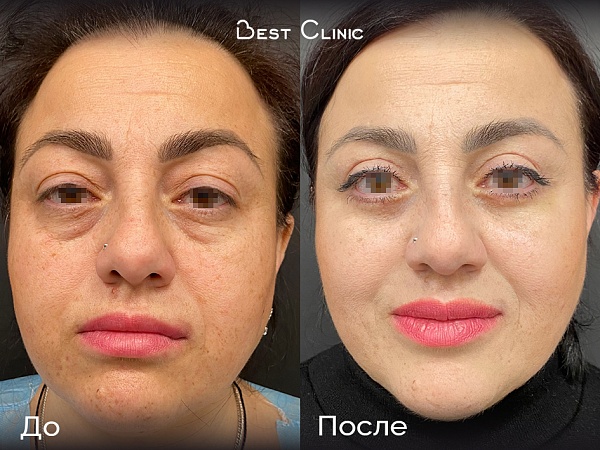 Верхняя и нижняя блефаропластика