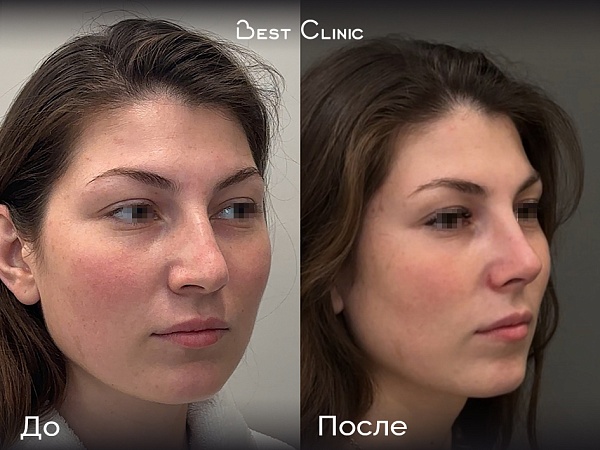 Ринопластика