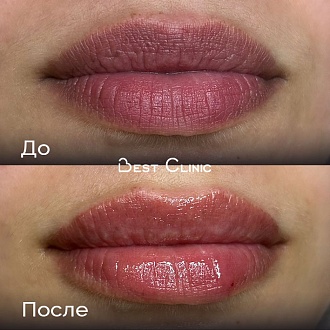 Контурная пластика губ (Belotero Lips Contour)