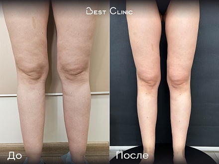 Липосакция голеней при липедеме голеней 2 степени