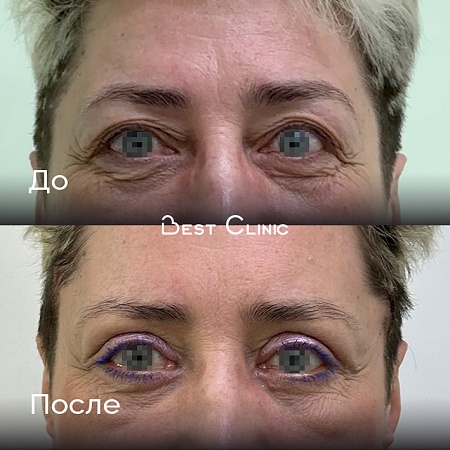 Круговая блефаропластика