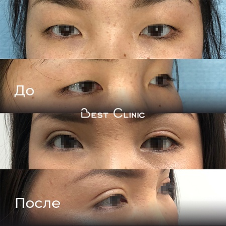 Азиатская блефаропластика