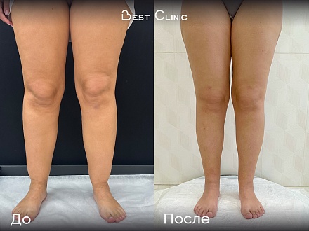 Липосакция голеней при липедеме нижних конечностей 2 степени
