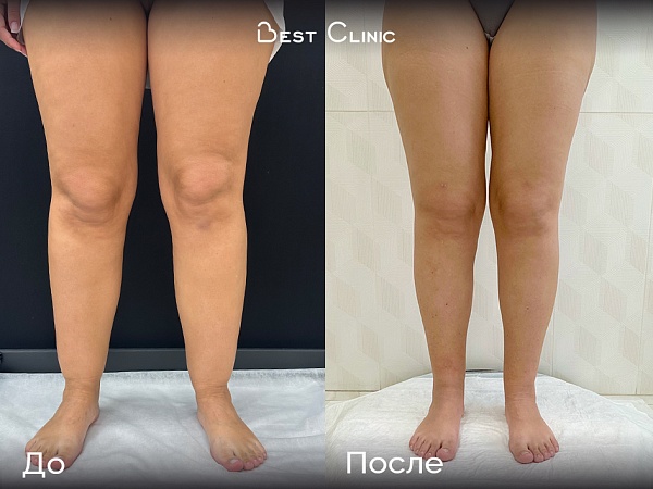 Липосакция голеней при липедеме нижних конечностей 2 степени