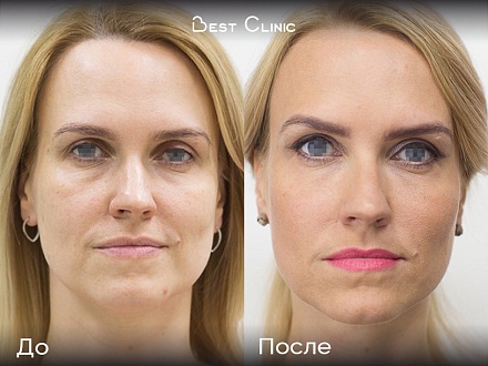 Лазерное омоложение, нитевой лифтинг, ботулинотерапия, контурная пластика