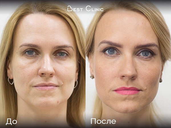 Лазерное омоложение, нитевой лифтинг, ботулинотерапия, контурная пластика