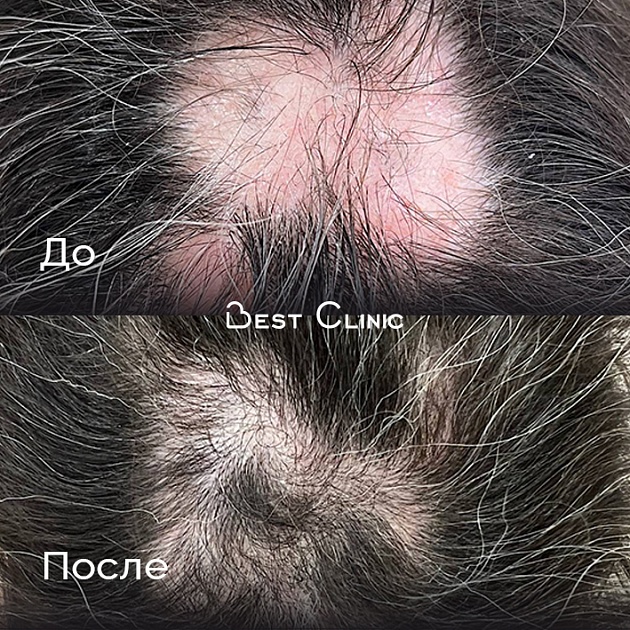 Лечение гнездной алопеции. Промежуточный этап