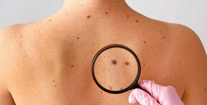 Бесплатная диагностика родинок и скидка 20% на удаление