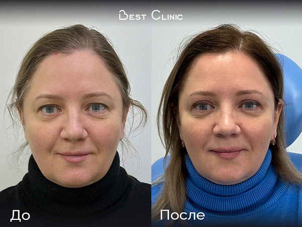 Верхняя блефаропластика