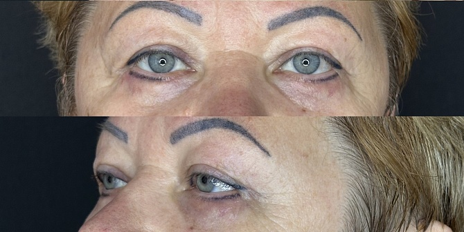 Блефаропластика