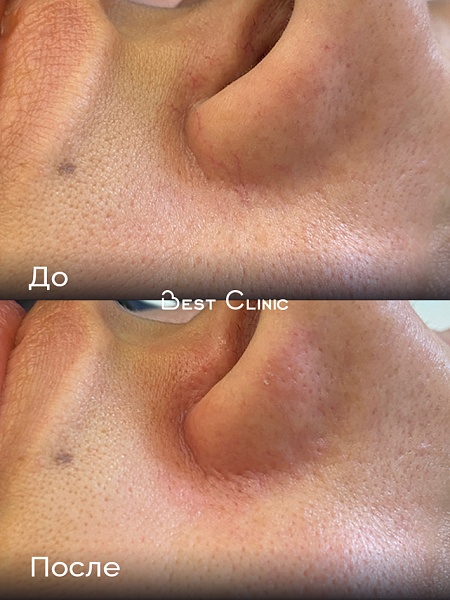 Удаление сосудов на носу на аппарате Candela