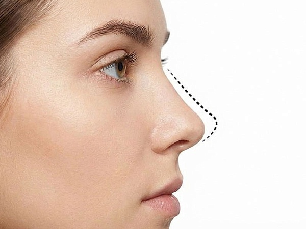 Ринопластика — пластика носа