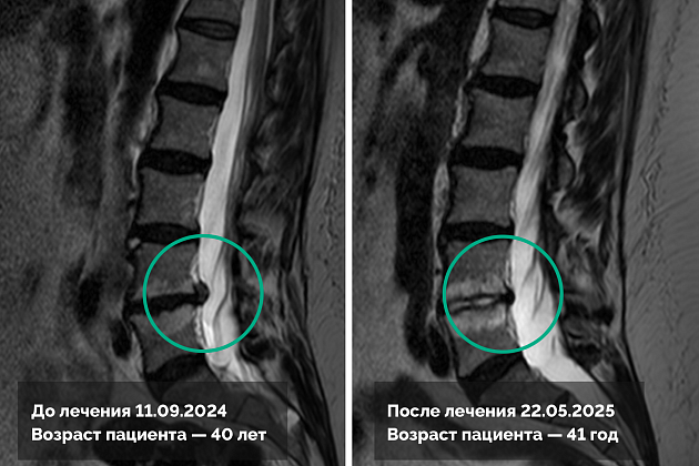 Лечение грыжи поясничного отдела позвоночника