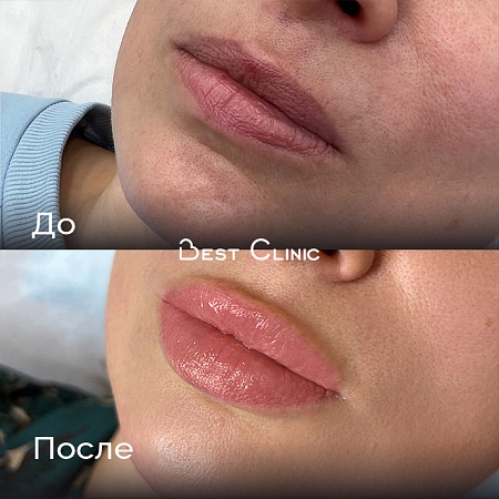 Увеличение губ-10