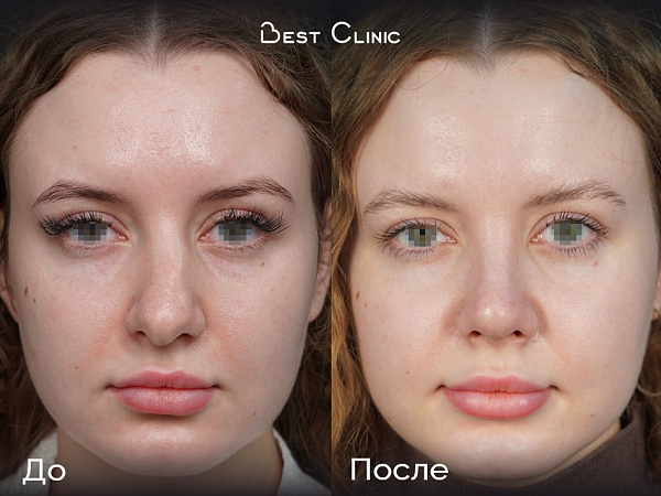 Риносептопластика