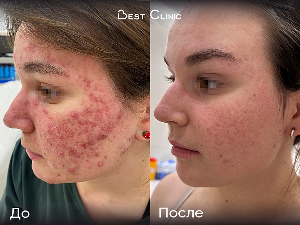 Лечение акне