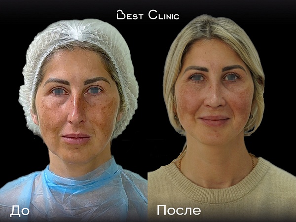 Риносептопластика