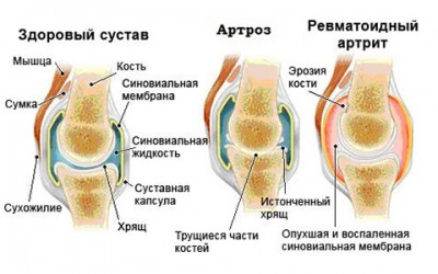 Лечение артроза суставов